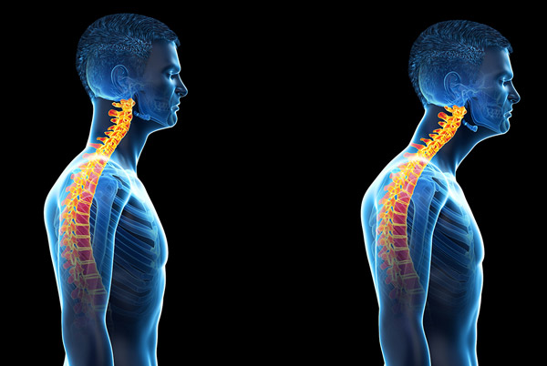 Postür Bozuklukları Nasıl Aşılır? / Fizyoterapist Elif Varan Altun